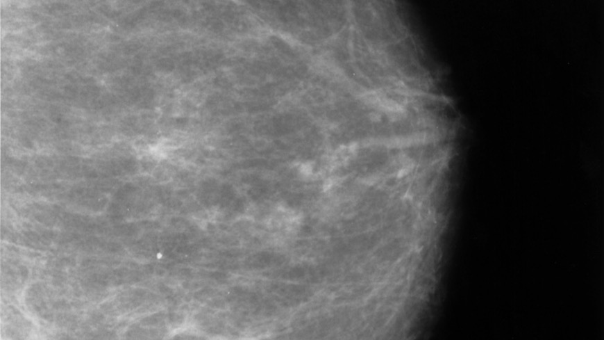 A screening mammogram showing breast tissue